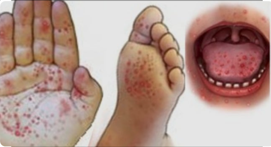 혀&middot;손발에 수포 발열&rdquo;&hellip;여름철 영유아 수족구병 주의보 관련 이미지