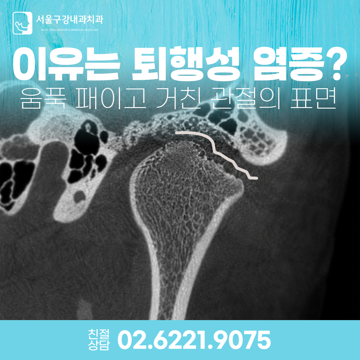 턱관절 CT 영상에서 개구 시 턱관절 디스크와 관절 움직임 이상을 보여주는 개구제한 원인 설명 이미지