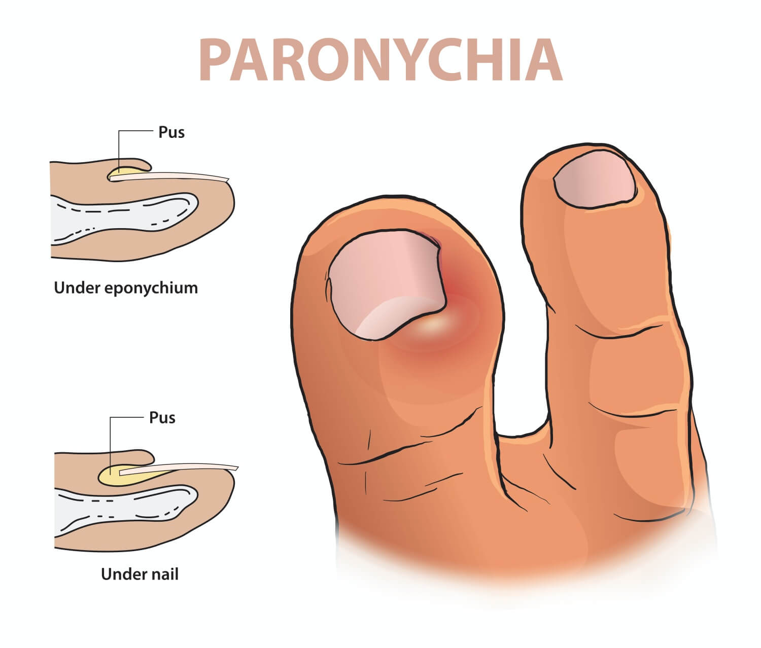발톱에-생긴-조갑주위염