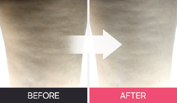 쥬비컷내돈내산,쥬비컷 슬리밍 랩핑 후기,쥬비컷 팔뚝 효과,쥬비컷 부작용 후기,다이어트 패치,붓기 제거,셀룰라이트 패치