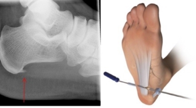 족저근막염 이미지