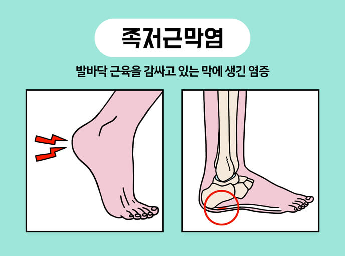 족저근막염을 설명하는 발의 구조 설명