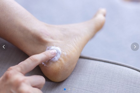 보습제를 사용하여 발의 건조와 갈라짐을 예방(매일신문)