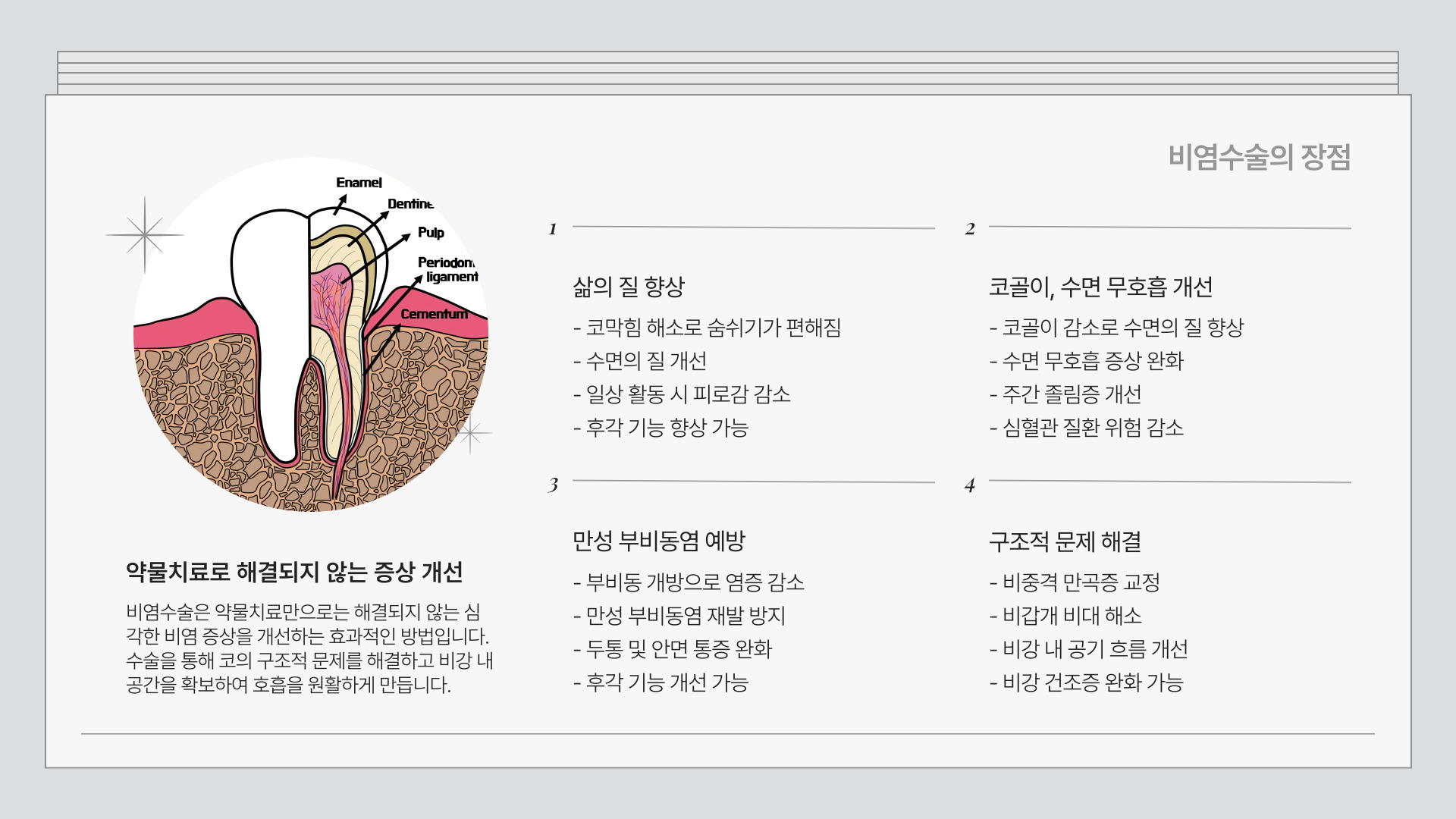 비염수술