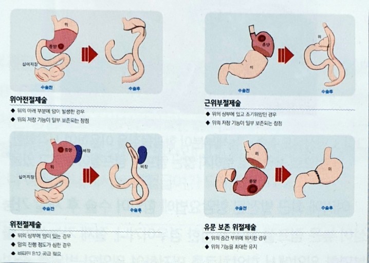 위암 수술 이미지