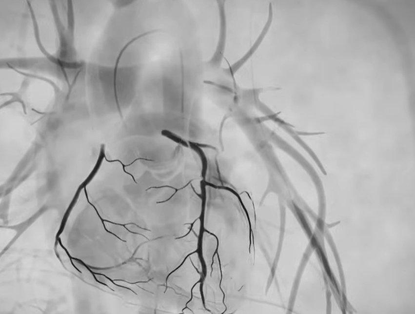 관상동맥 조영술