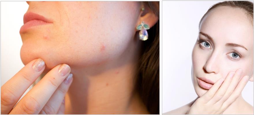 트러블피부와-깨끗한피부-비교사진