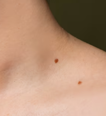 피부암 초기증상 9