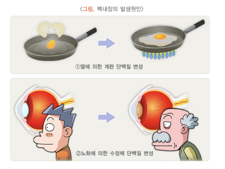 백내장 발생원인