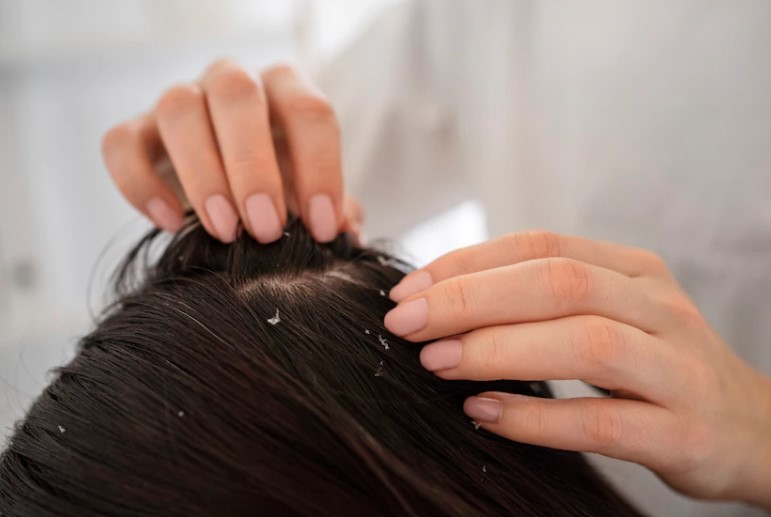 탈모원인비듬
탈모근본대책
탈모비듬원인
비듬탈모