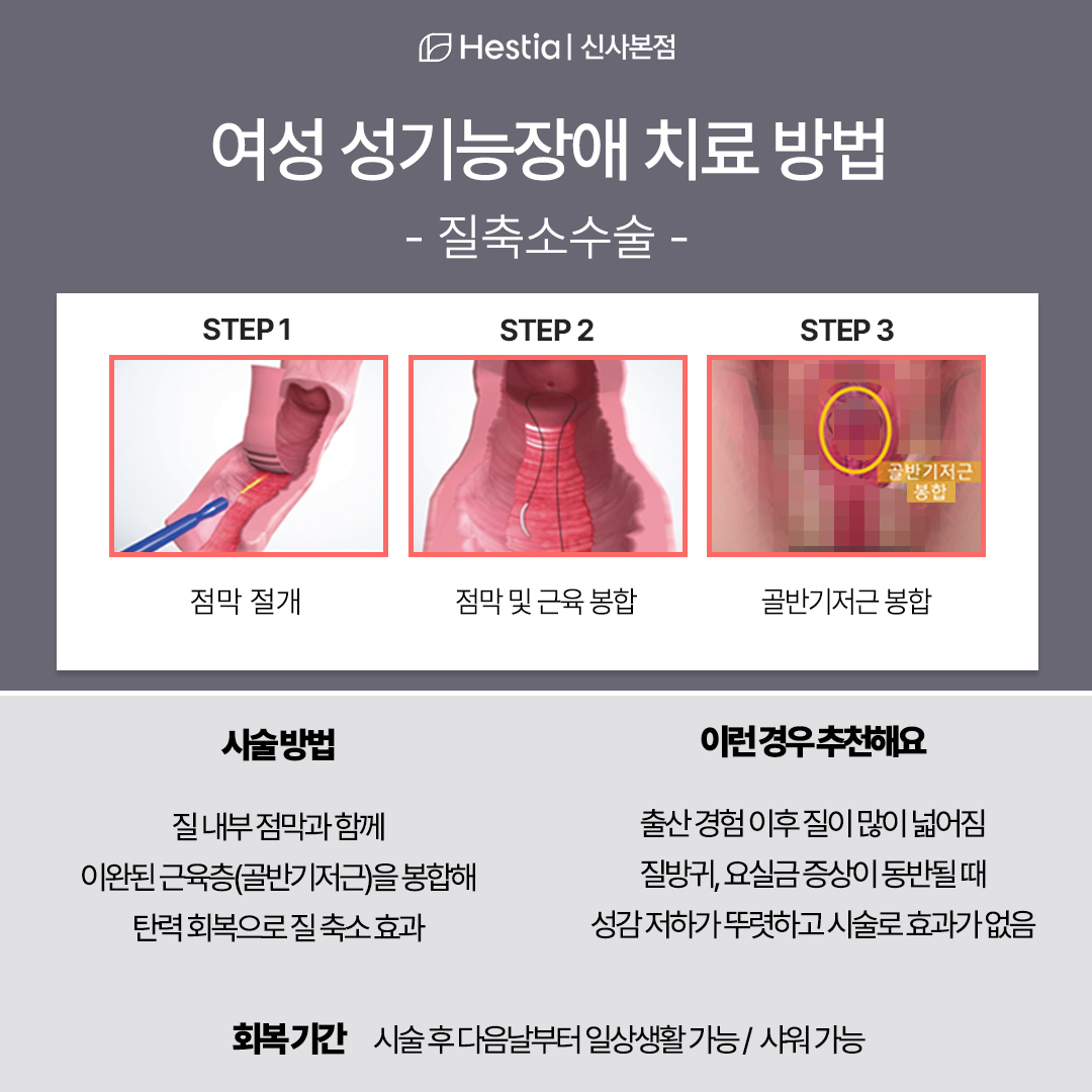여성 성기능장애 치료 방법 -질축소수술-