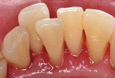 치석제거후 모습