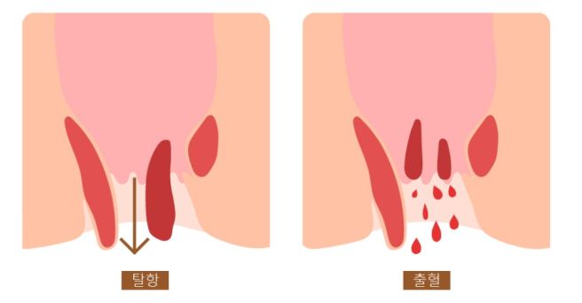 혈변의 원인