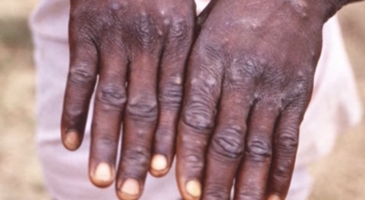 원숭이두창 이미지