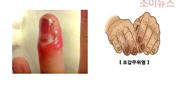 조갑주위염(손톱 주변 염증)