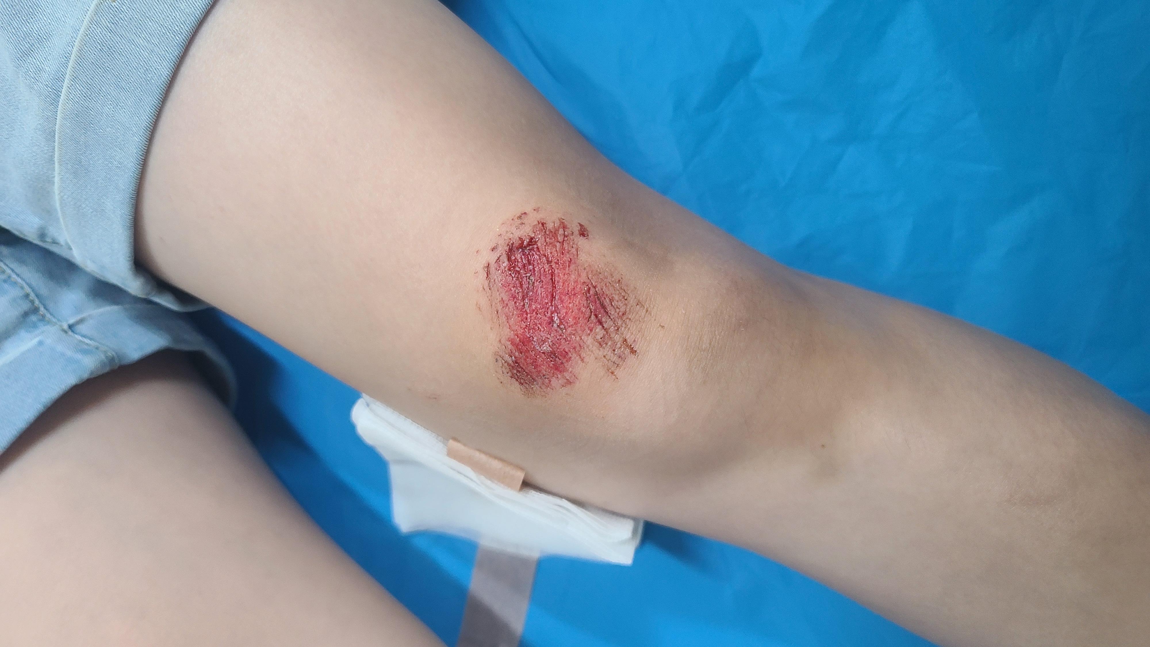 넘어져서 생긴 무릎 상처, 정형외과에서 드레싱 받기 전