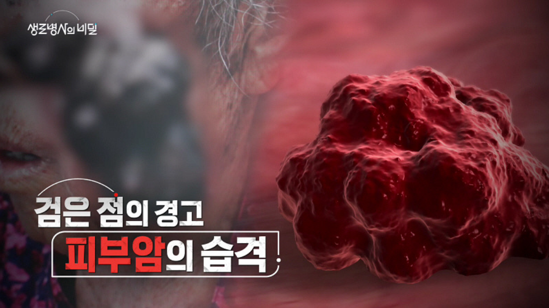 생로 병사의 비밀 악성 흑색종