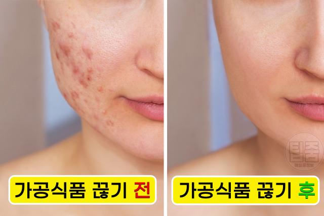 가공식품 끊기 피부 여드름