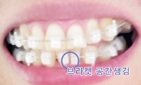 클라리티치아교정