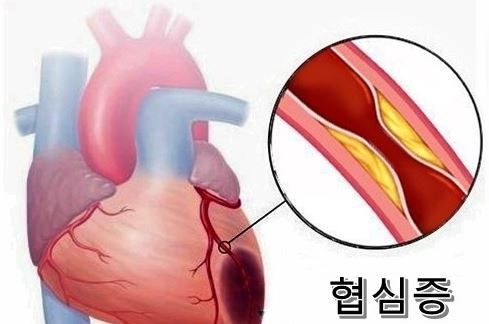 협심증