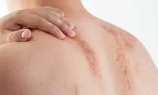 피부 붉은반점 34