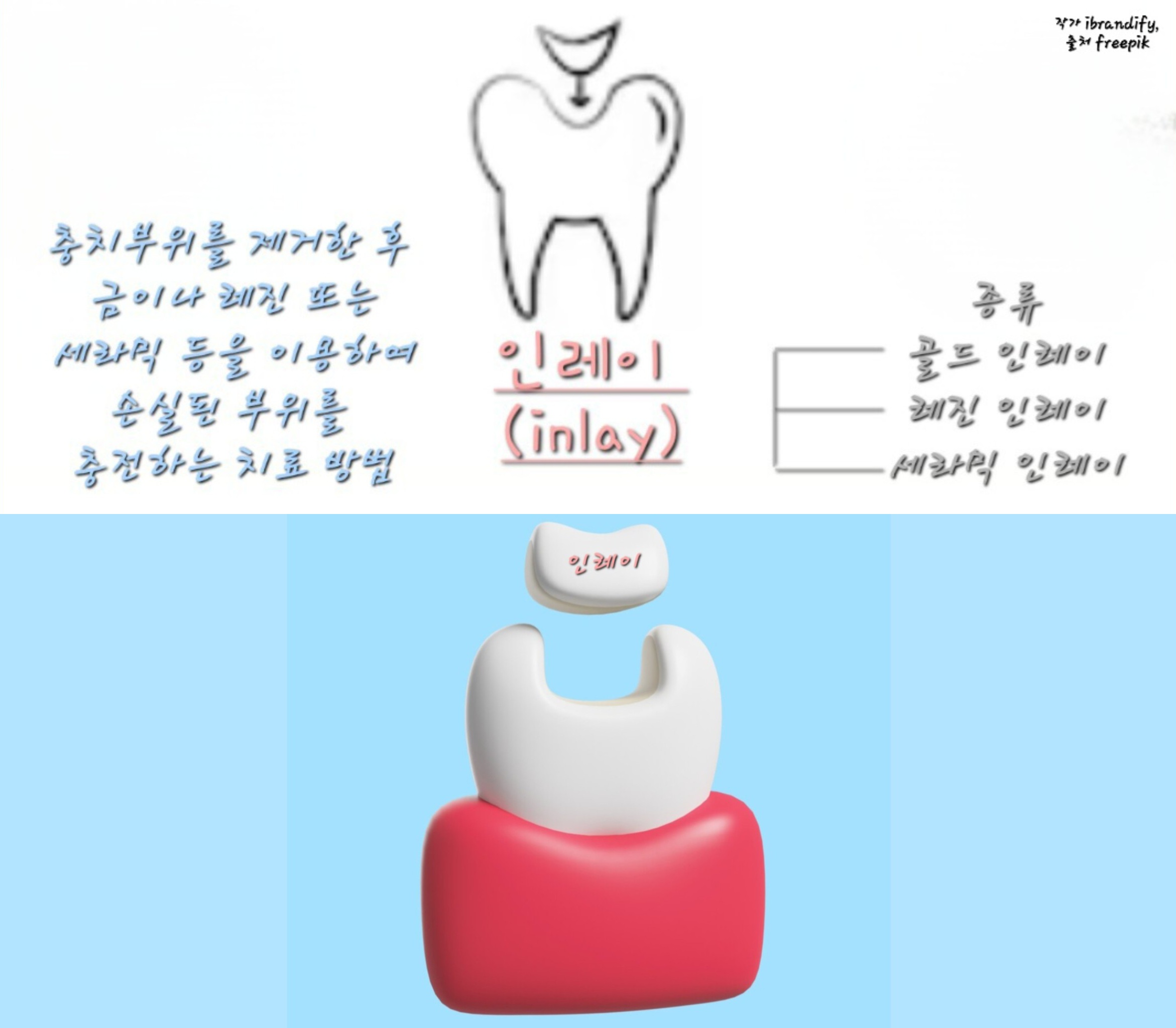 인레이치료