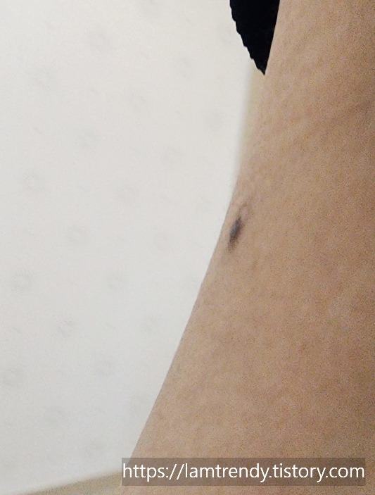 쥐젖 냉동치료후 한달