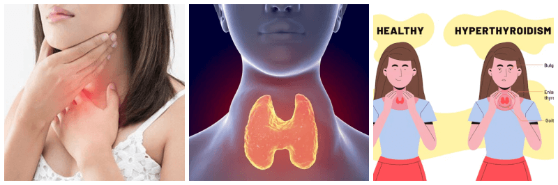 갑상선 기능 항진증 관련 사진 3개