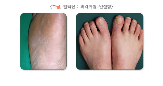 인설형 무좀