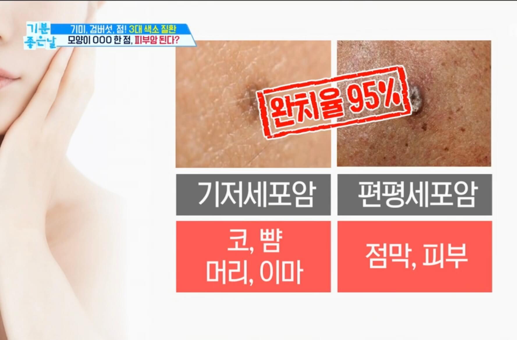 피부암