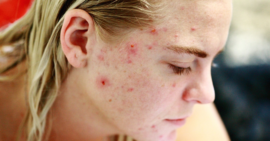 여드름-다이어트-피부관리-항염증-피지분비-장내환경-호르몬