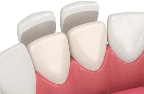 래미네이트 시술 이미지