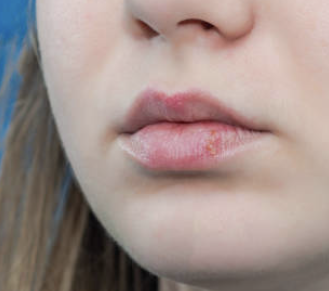 입술에 물집이 생기는 이유 28