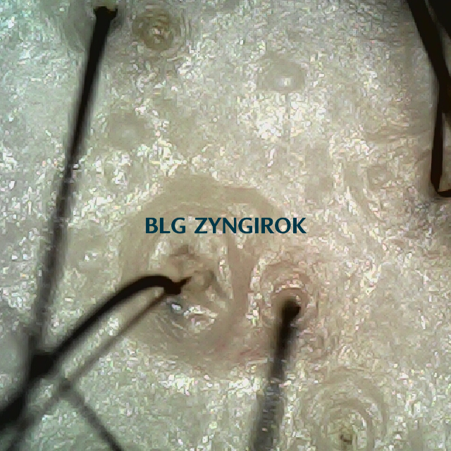 탈모 극복 프로젝트 - 정수리와 이마 사이 두피 모습이다.