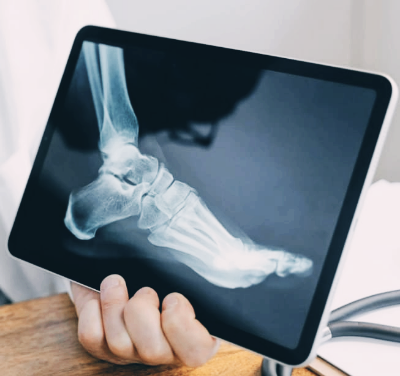 복숭아뼈 통증과 아래 통증, 골절일까?