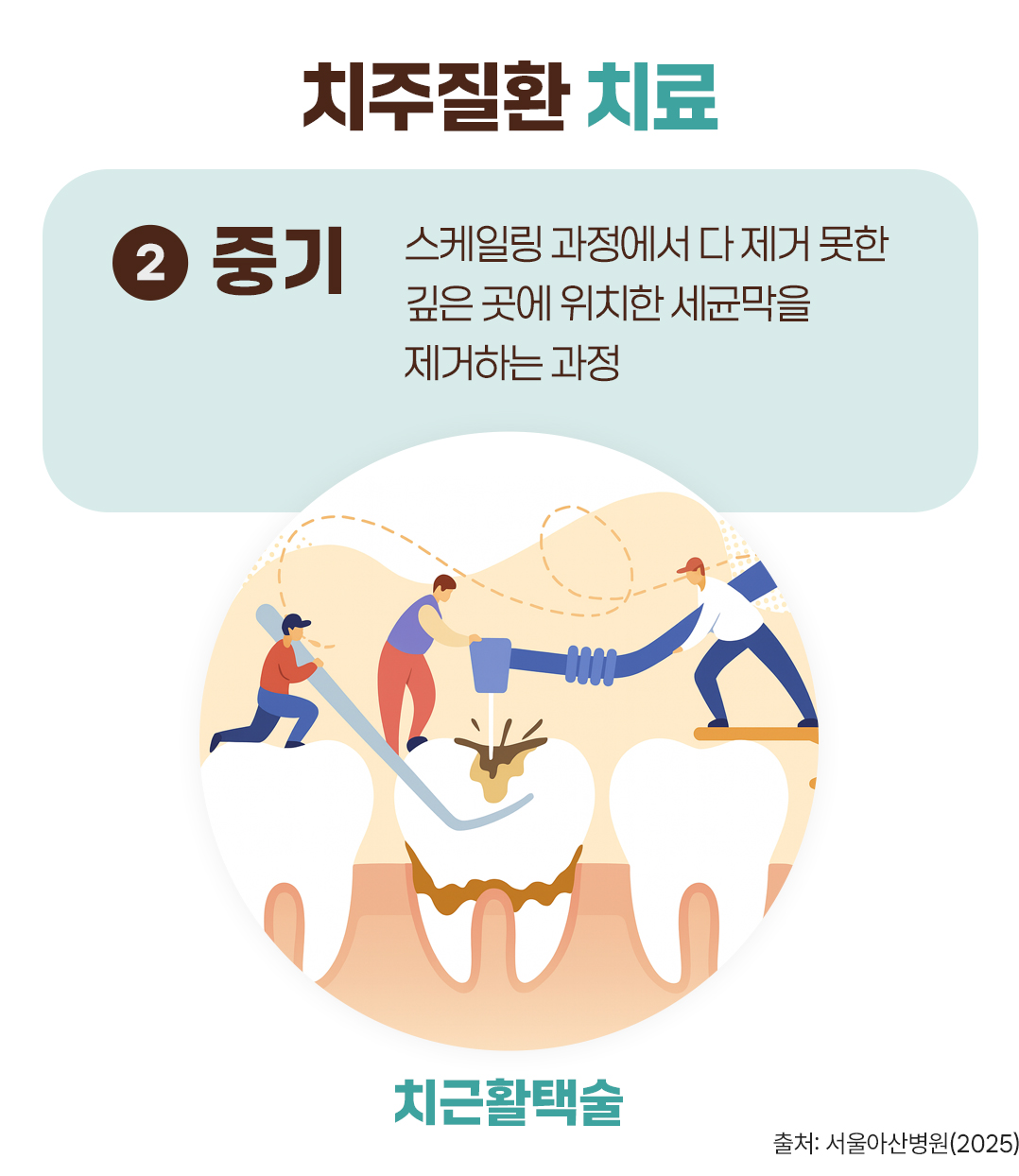 #치주질환 치료 #중기 #치근활택술