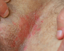 칸디다증 칸디다 감염 칸디다 치료 칸디다 증상 부위별 키워드 구강 칸디다증 (아구창) 질 칸디다증 피부 칸디다 식도 칸디다 칸디다 골관절염 칸디다 복막염 간비장 칸디다증 원인 및 치료 관련 키워드 칸디다증 원인 칸디다 감염 원인 칸디다증 치료법 칸디다 연고 칸디다 항진균제 칸디다증 면역력 강화 예방 및 생활습관 키워드 칸디다증 예방 칸디다에 좋은 음식 칸디다에 좋은 습관 항생제 부작용 칸디다 음식 관련 키워드 칸디다증에 좋은 음식 칸디다 억제 식품 마늘 칸디다 억제 칸디다 녹황색 채소 오메가3 칸디다 기타 연관 키워드 칸디다 전염성 칸디다증 생활 습관 칸디다증 자가진단 칸디다 곰팡이 감염 칸디다증 면역력