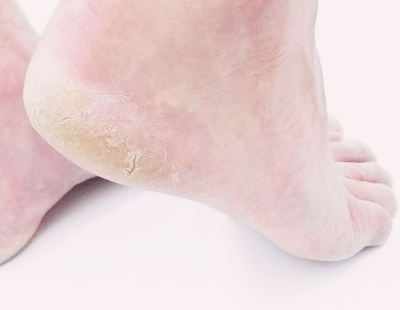 티눈 없애는 방법