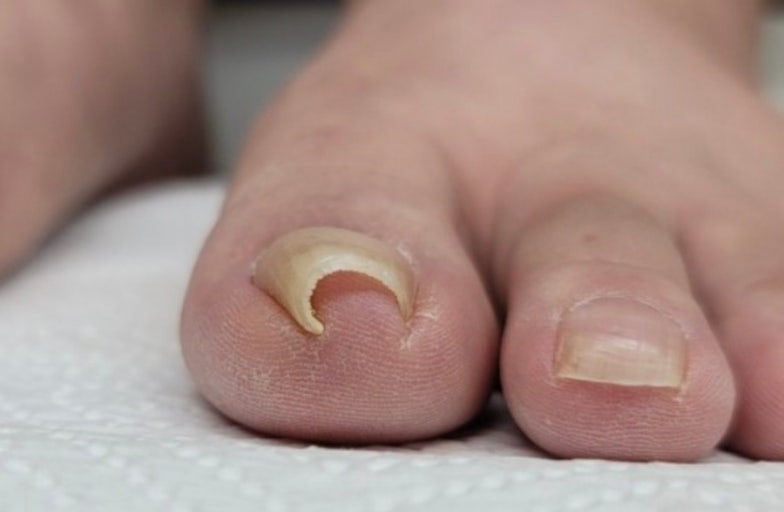 내성발톱의 모습