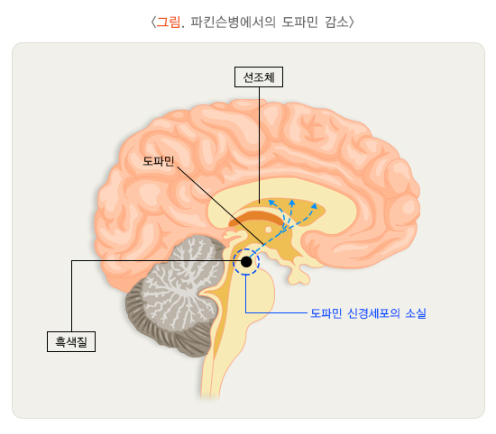 파킨슨병 사진