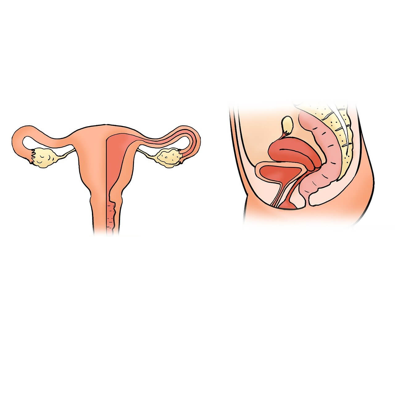 다낭성 난소증후군 증상