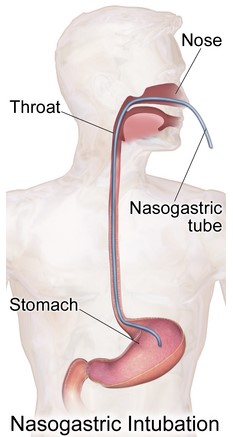 비위관경관튜브 그림