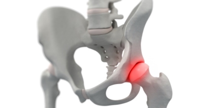 고관절 이미지
