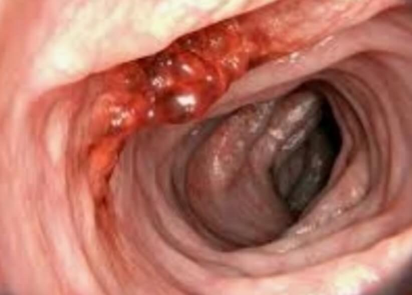 대장내시경 모습