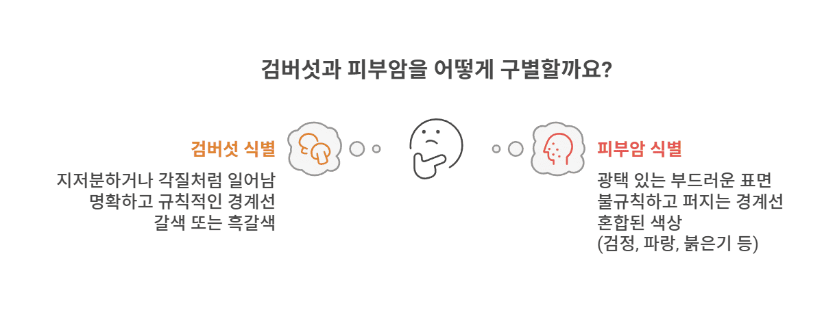 검버섯(지루각화증)과 피부암과의 구별