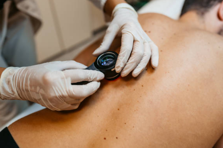 쥐젖 제거방법, 쥐젖이 생기는 이유, 제거 연고 총정리 (2024ver)