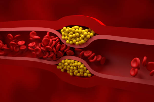 중성지방의 원인과 수치, 관련 질환, 예방과 관리 방법