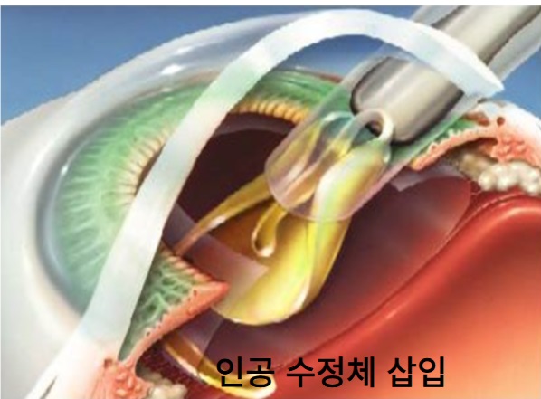 백내장 수술 방법-인공수정체 삽입 모습