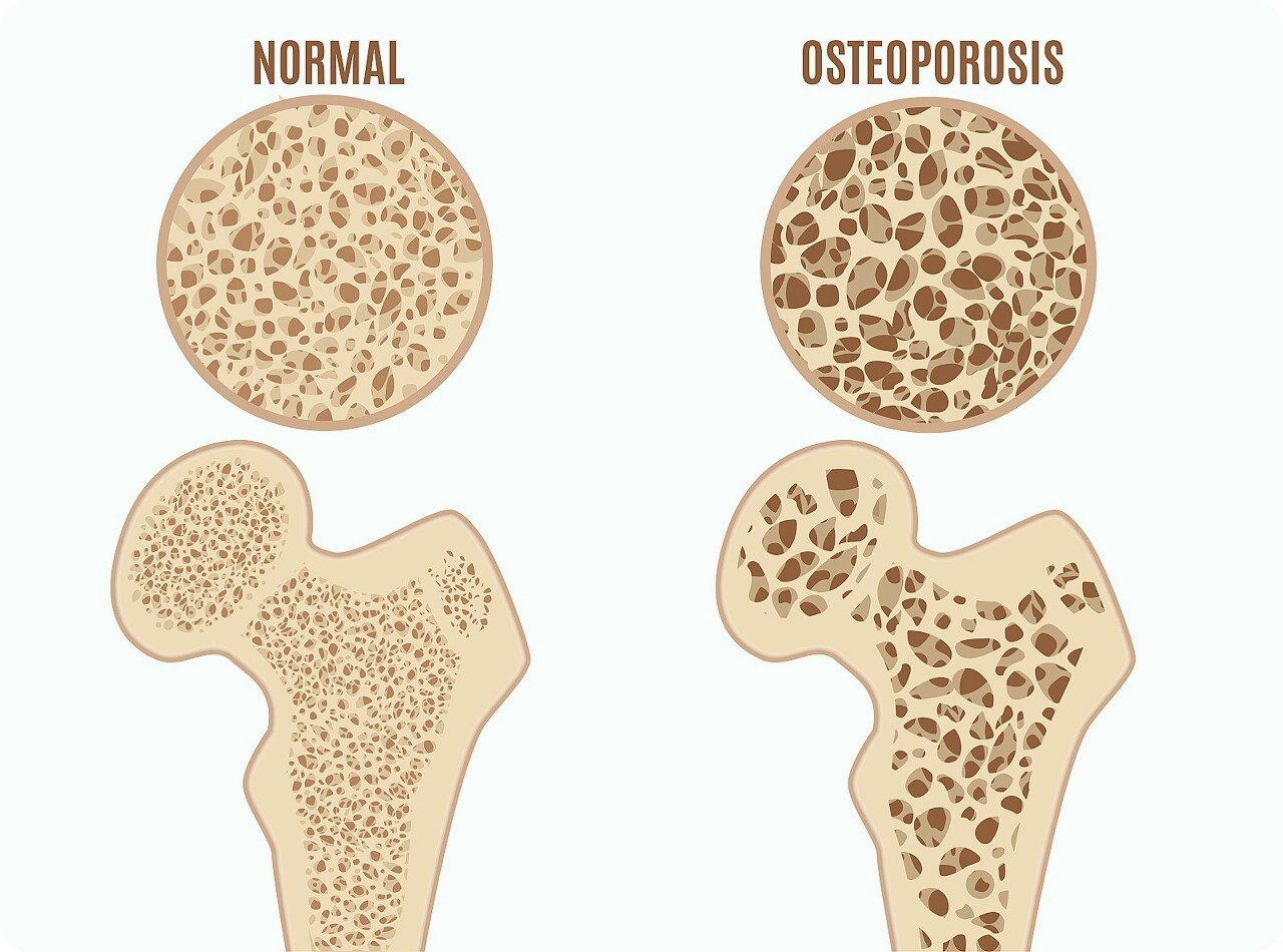 비타민d-부족증상
