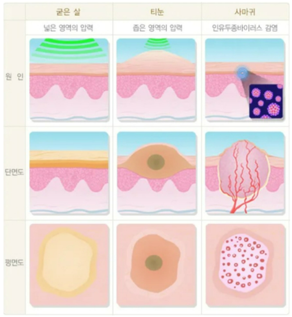 약국 티눈약으로 뿌리까지 제거하려면, 어떻게 해야할까?